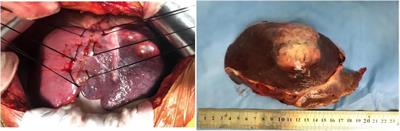 Primary hepatic neuroendocrine tumor associated with hypertension: A case report